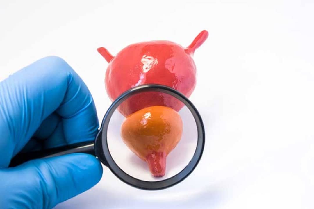 Prostate Cancer